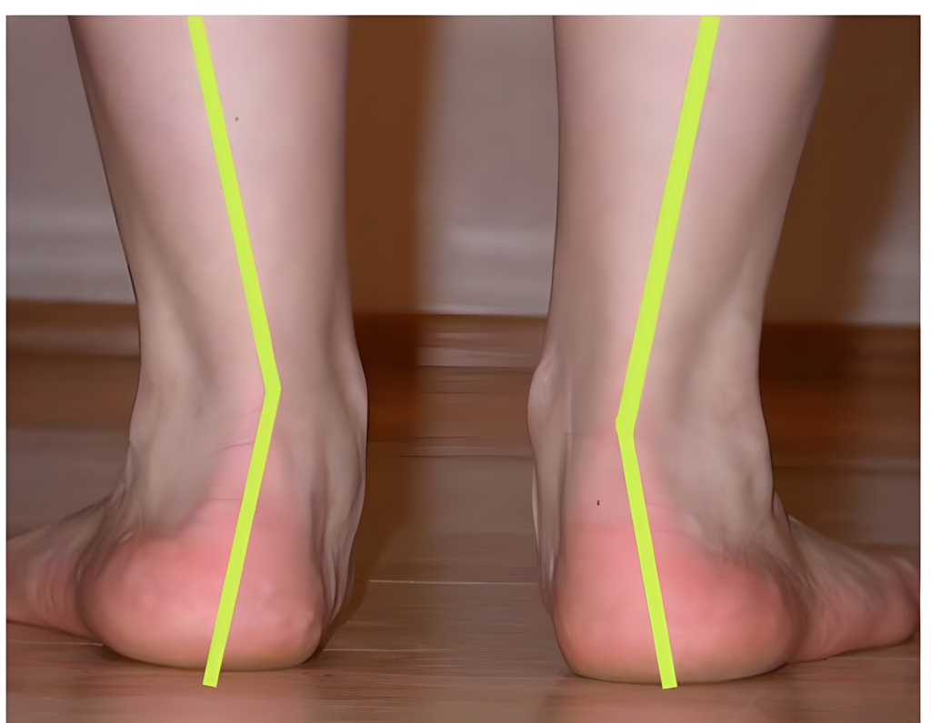 The difference between a normal foot and a flat foot